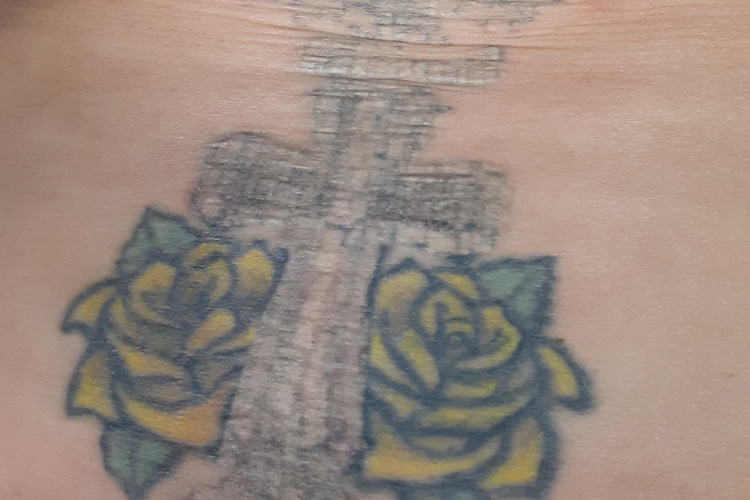Tattoo Removal of Cross on Back with Laser