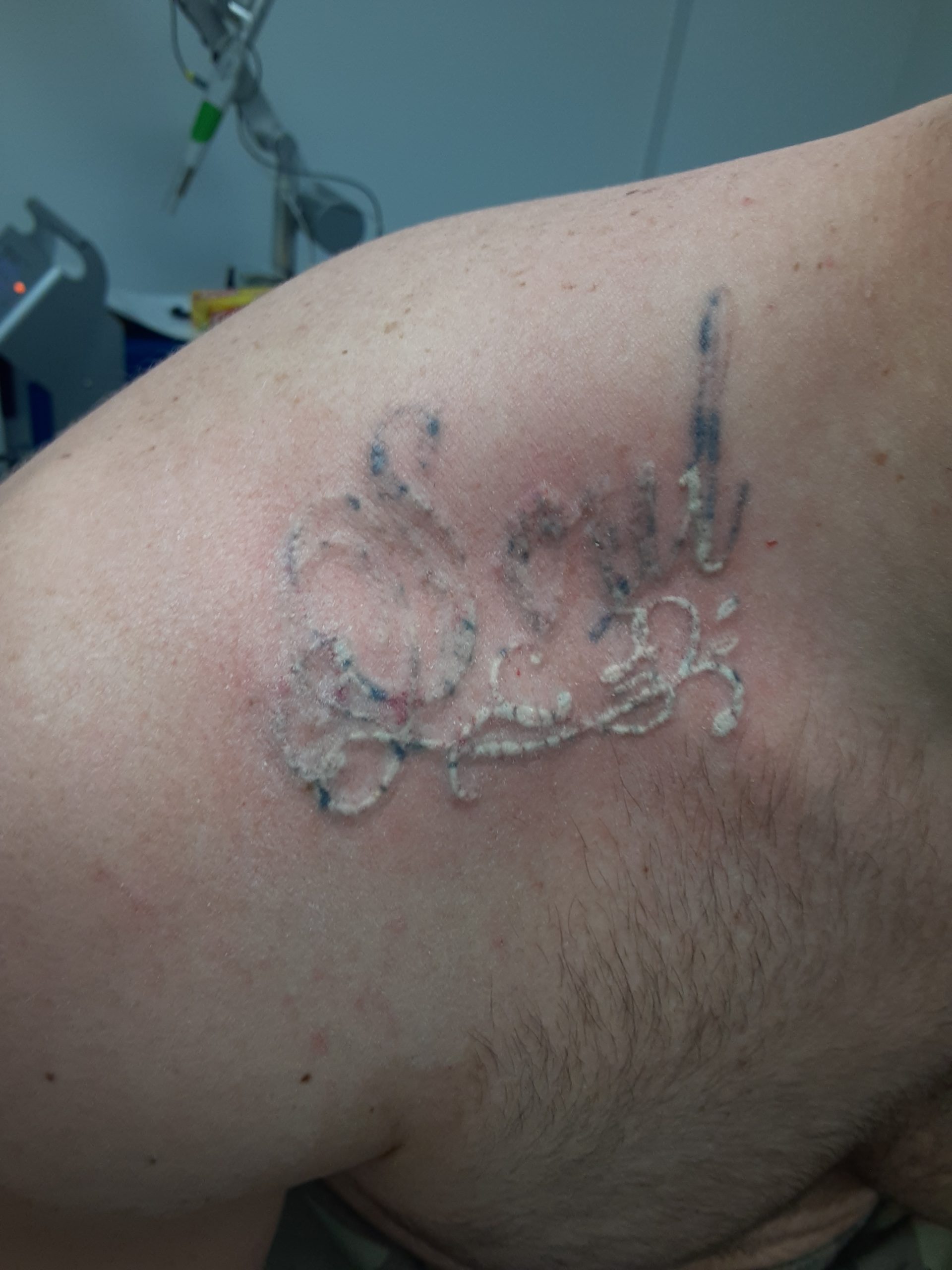 Laser Tattoo Removal Before and After Photo