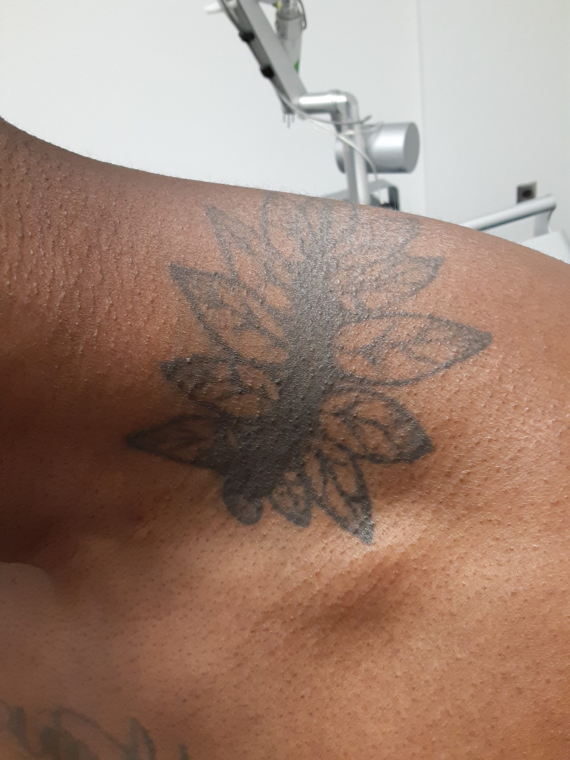 Laser Tattoo Removal Before and After Photo