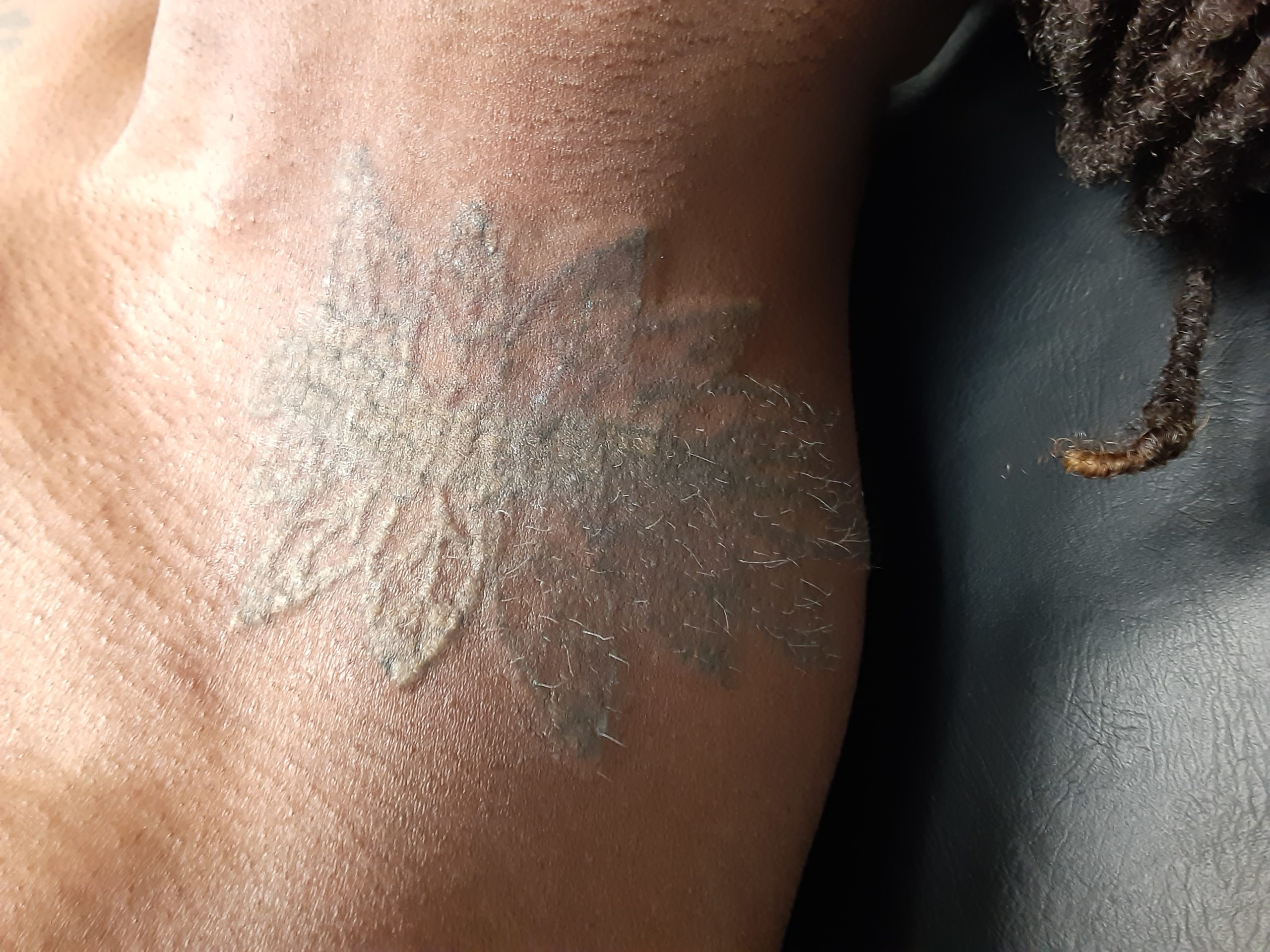 Fearless Tattoo Removal After Photo