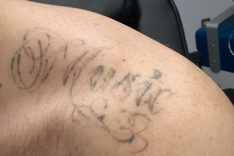 Laser Tattoo Removal of Script Text on Shoulder