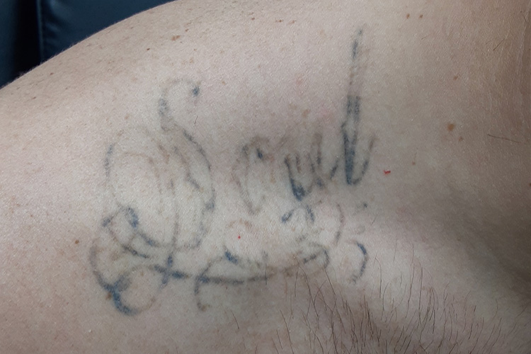 Expert Tattoo Removal of Script Text on Shoulder