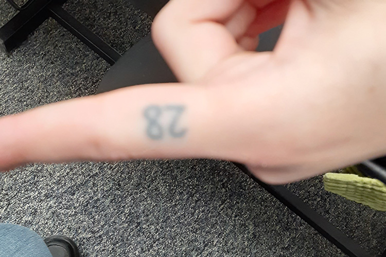 Tattoo Removal on Index Finger of The Number 28