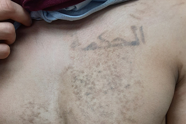 Semi Removed Chest Tattoo