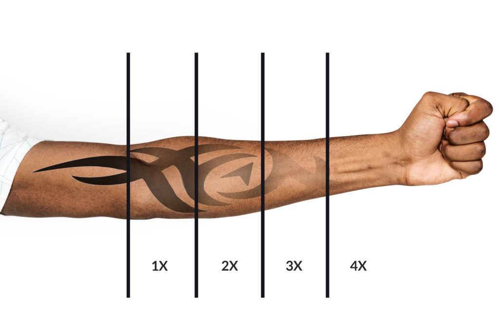 Tattoo Removal Arm Progression