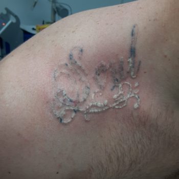 Laser Tattoo Removal Before and After Photo