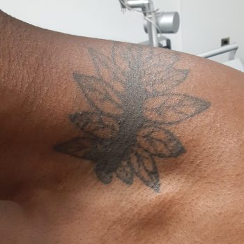 Laser Tattoo Removal Before and After Photo