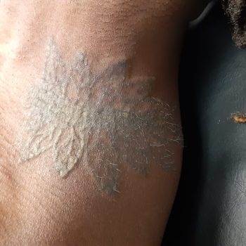 Laser Tattoo Removal Before and After Photo