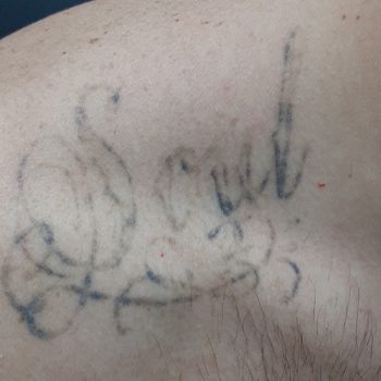 Expert Tattoo Removal of Script Text on Shoulder